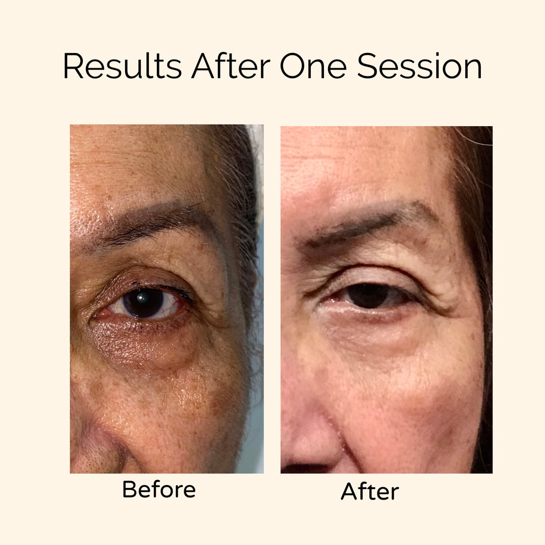 Facial Rejuvenation: wrinkles, sun damage, roughness, large pores