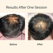 Hair Loss: pattern baldness, receding hairline, thinning hair